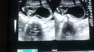 ultrasound fetal anomaly scankeyhole sign in posterior urethral valvesFetal ultrasound [upl. by Nottus]