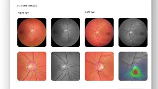 AI powered fundus camera to screen glaucoma  Remidio [upl. by Arlie]