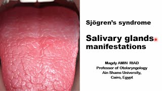 Sjögren’s syndrome Salivary glands manifestations [upl. by Yukio734]