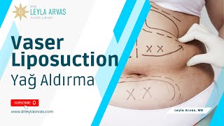 Yağ Aldırma  Vaser Liposuction Liposakşın Ameliyatı  Op Dr Leyla ARVAS VaserLiposuction [upl. by Yelnet675]