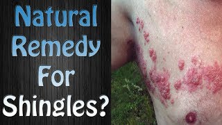 Amazing Natural Remedy for Shingles Yes Home Treatment for Shingles and Shingles Pictures [upl. by Nomrah]