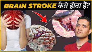 Causes Symptoms And Treatment Of Ischemic Brain Stroke  Dr Gaurav Gangwani IR [upl. by Erdnassak]