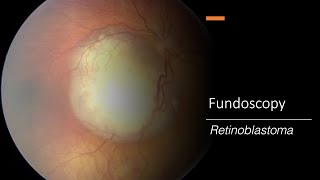 Retinoblastoma Fundoscopy [upl. by Dranal]