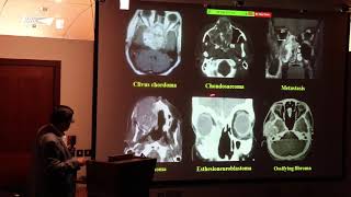 Aneurysmal bone cyst in skull base ABC 13 [upl. by Olim406]