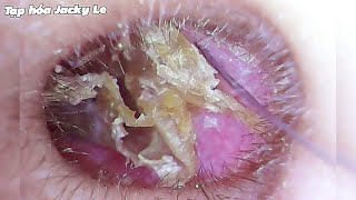 Ear Wax Removal 85 Earwax Is BigThick And Very Itchy  Ear Cleaing ASMR [upl. by Nicolis868]