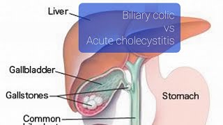 Biliary colic vs acute cholecystitis [upl. by Rutter]