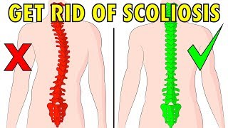 How to fix scoliosis naturally in 4 minutes a day [upl. by Katherina]