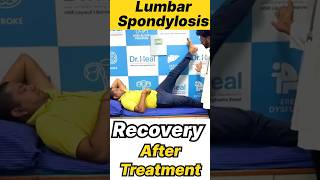 Lumbar Spondylosis Recovery After Treatment yt ytshorts ytshortsindia india kgf [upl. by Bridges708]