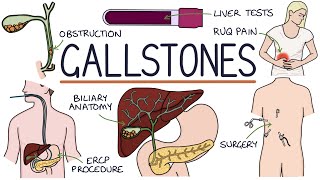 Understanding Gallstones [upl. by Baptlsta]