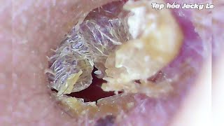 Ear Wax Removal 71 Earwax Is Dry And Sticks To The Skin  Ear Cleaning ASMR [upl. by Daughtry471]