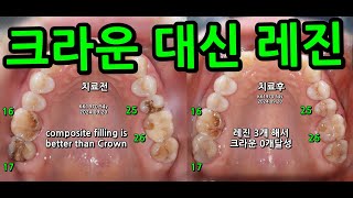 크라운 대신 레진하기 크라운과 신경치료는 최후의 수단으로 최대한 하지 말아야 한다 대부분 레진하면 충분함 하악 대구치는 힘을 많이 받으니 크라운금지 20240928 [upl. by Olegnaid283]