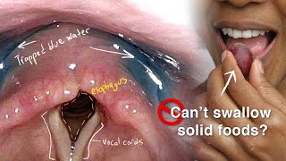 Cricopharyngeal Dysfunction Difficulty Swallowing Especially Solid Foods [upl. by Prunella960]