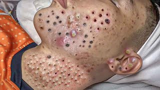 Big Cystic Acne Blackheads Extraction Blackheads amp Milia Whiteheads Removal Pimple Popping  8354 [upl. by Andeee]