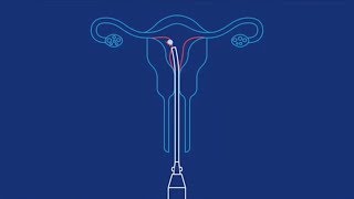 Suction abortion inaccurately described by Planned Parenthood [upl. by Agler]