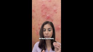 InOffice Cyst Treatment Shrink Acne in Just 24 Hours [upl. by Sucramrej]