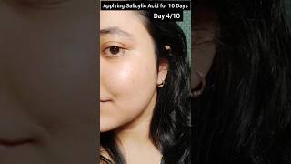 Day 4 of Applying Salicylic Acid for 10 days the dermaco salicylic acid serum skincarebeautylove [upl. by Eiderf940]