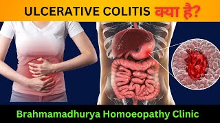 quotUlcerative Colitis Understanding Homeopathic Treatments and Effective Managementquot [upl. by Rennie]