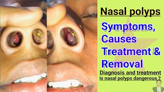 nasal polyps nose polyps treatment  Nasal polyps causes  Nosel polyps symptoms How to remove it [upl. by Tanberg]