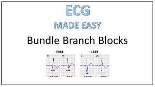 ECG  Bundle Branch Blocks  Trick to remember [upl. by Monto516]