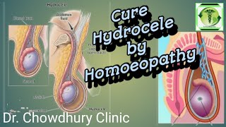 Hydrocele l हाइड्रोसिल l Homoeopathic medicines for hydrocele l [upl. by Ambrose190]