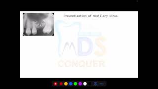 PNEUMATIZATION OF MAXILLARY SINUS  MDS CONQUER  NEET MDS  INICET MDS  ORAL SURGERY [upl. by Aleacin]