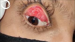 Giant Papillary Conjunctivitis [upl. by Pool]