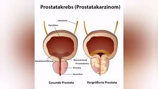 Prostatakrebs Ursachen Diagnose und Therapie [upl. by Reddin20]