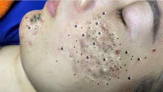 Big Cystic Acne Blackheads Extraction Blackheads amp Milia Whiteheads Removal Pimple Popping  9284 [upl. by Assilam]