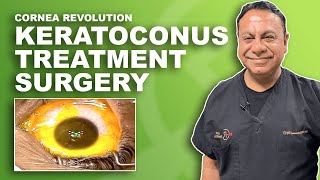 Keratoconus Surgery Laser Treatment [upl. by Elrem]