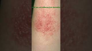 How I Manage My Dermatitis Tips for Soothing Irritated SkinDermatitisSkincareJourneySkinCareTips [upl. by Harrison593]