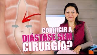 Como corrigir a diástase sem cirurgia [upl. by Airahcaz]