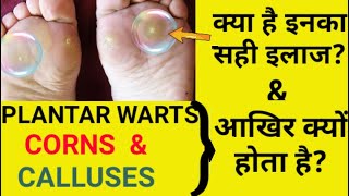 Plantar warts Corns amp Calluses Causes Symptoms amp Treatment [upl. by Adah]