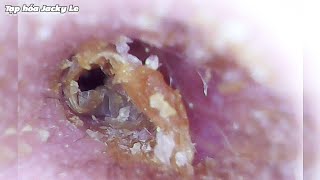 Ear Wax Removal 119 Earwax And Dead Skin Make Him Itch Unbearably  Ear Cleaning ASMR [upl. by Schechter]