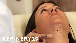 Kybella Double Chin Removal Treatment Up Close  Macro Beauty  Refinery29 [upl. by Powel]