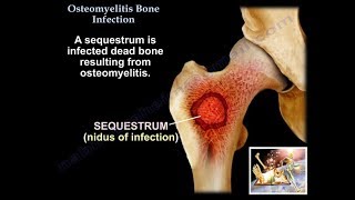 Osteomyelitis Bone Infection  Everything You Need To Know  Dr Nabil Ebraheim [upl. by Acinemod]