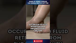 Signs of Kidney Disease You Should Watch Out For shorts [upl. by Silyhp669]