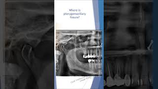 OPG LANDMARKS series Pterygomaxillary fissure oral radiology dental opg [upl. by Margette]