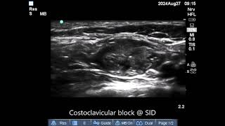 costoclavicular block  27 August 24 [upl. by Krefetz]