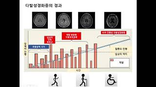 다발성경화증의 치료 1 [upl. by Ardien]