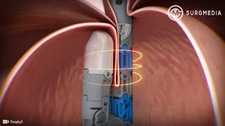 Endoscopic Treatment for GastroEsophageal Reflux Disease GERD or known as Acid Reflux [upl. by Joceline231]