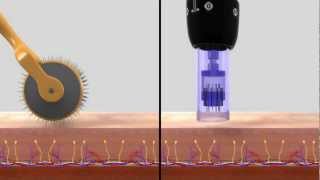 DERMAPEN SISTEMA DE REMODELACIÓN TISULAR [upl. by Brahear]