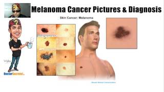 Spotting Melanoma Cancer and Symptoms with Pictures [upl. by Kalk]