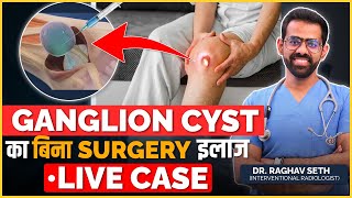 Live Ganglion Cyst Removal Case Without Surgery  Non Surgical Treatment of Ganglion Cyst [upl. by Ahen]