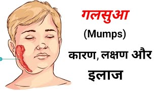 Mumps क्या है इसके लक्षण क्या है कारण क्या है और इलाज क्या है  Mumps Treatment in Home Remedies [upl. by Aehcim]