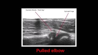 PEM POCUS UK  Visualising the real time reduction of pulled elbow using POCUS [upl. by Aisena744]