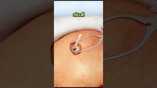 Ventriculostomy Brain Fluid Drainage Surgery [upl. by Cila]