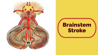 Brainstem Stroke Syndromes [upl. by Depoliti984]