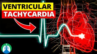 Ventricular Tachycardia Vtach  Medical Explainer Video [upl. by Edas]