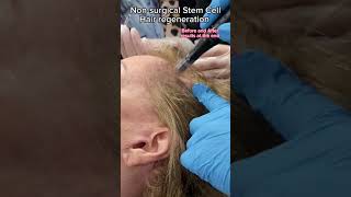 Hair growth and Strengthening Microneedling treatment with end results at Dr Medispa [upl. by Ezitram237]