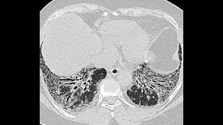 Fibrose pulmonar [upl. by Desdemona]